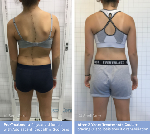 AIS Adolescent Idiopathic Scoliosis