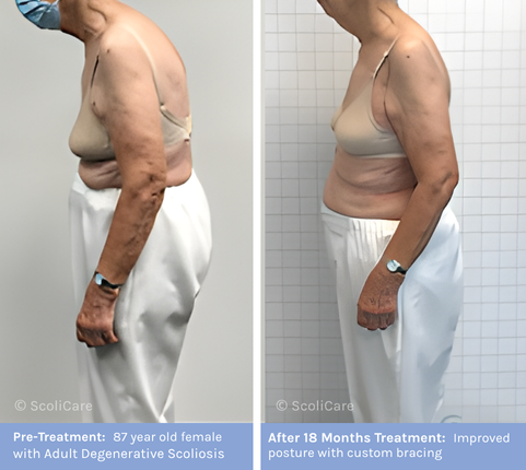 Adult Adult Scoliosis