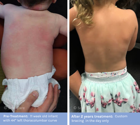 Infantile Infantile Scoliosis