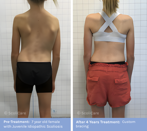 Juvenile Juvenile Scoliosis